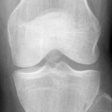 Anteroposterior knee radiograph